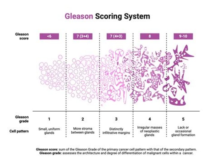 Can a Gleason score of 9 Be Cured
