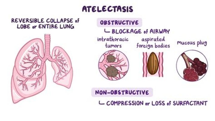 Can blood clots cause atelectasis