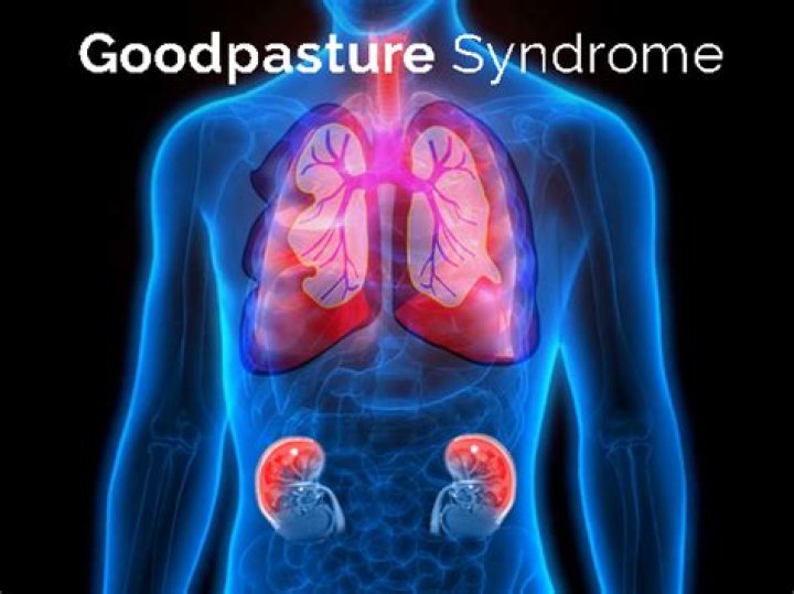 Can Goodpasture syndrome be cured