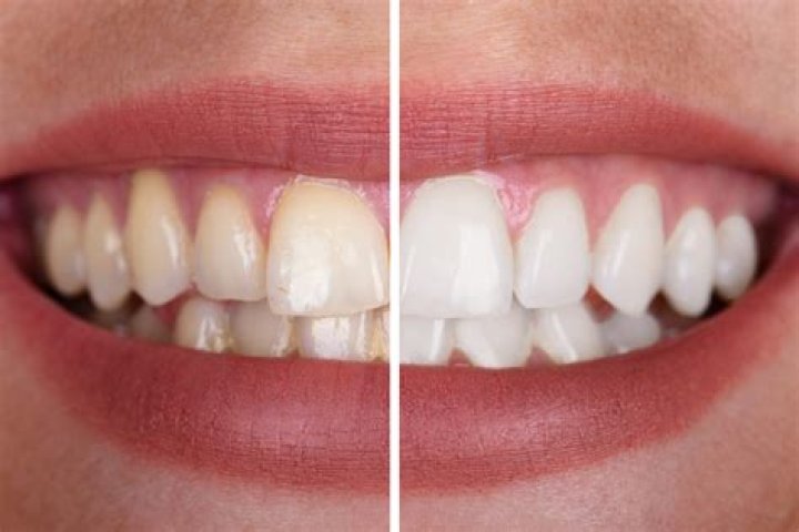 Can teeth whiten from brushing