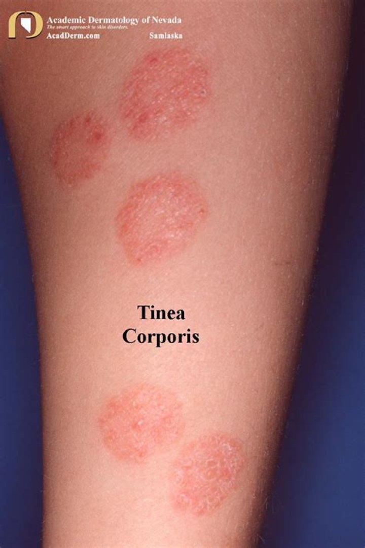 Can tinea cause blisters