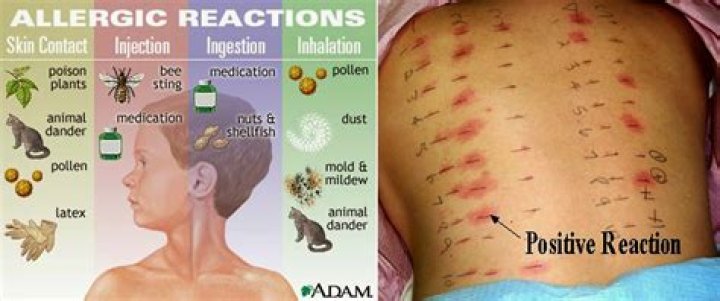 Can you be allergic to sutures