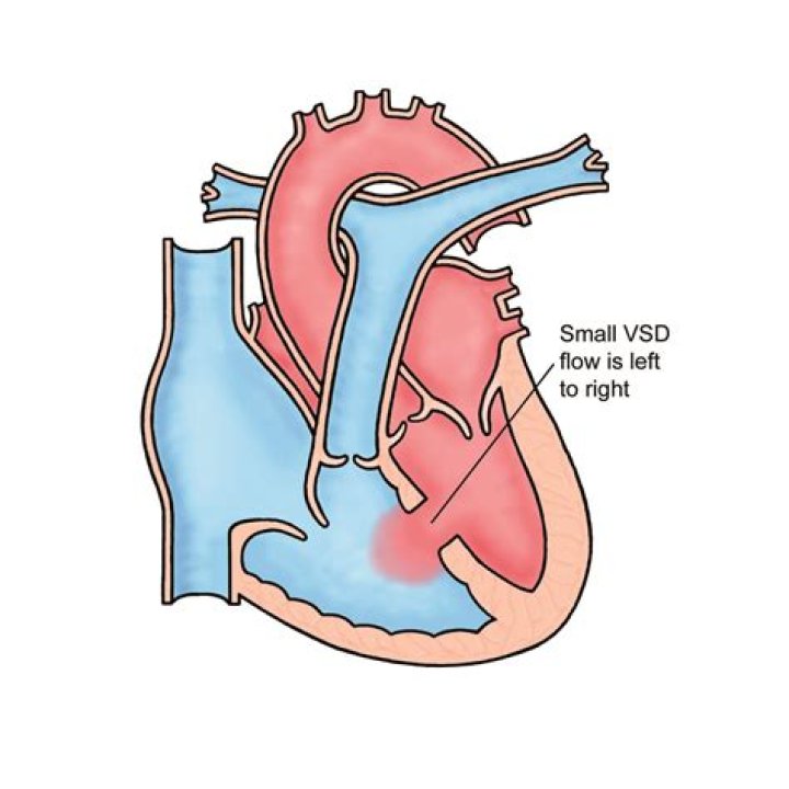 Can you develop a VSD as an adult