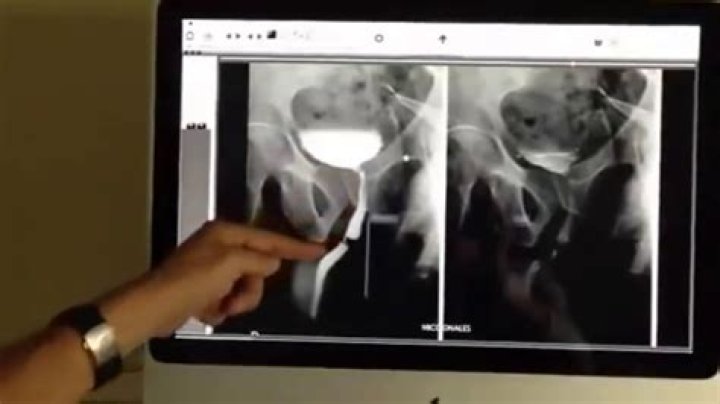 ¿Cómo se hace una pielografía