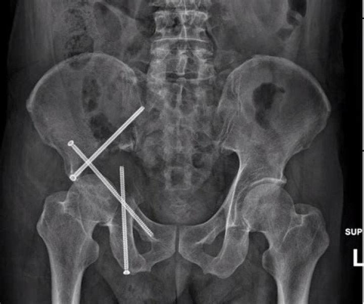 Does tripod fracture need surgery