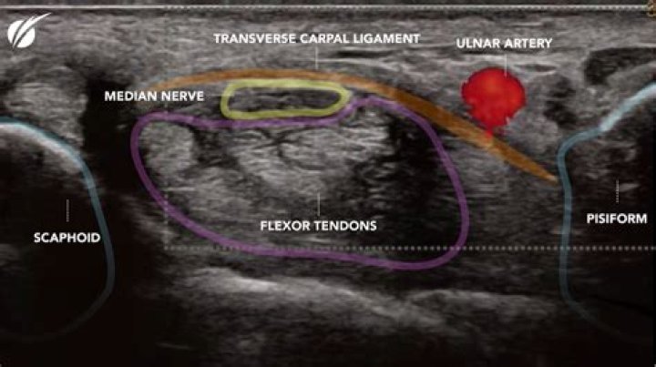 Does ultrasound help heal tendons