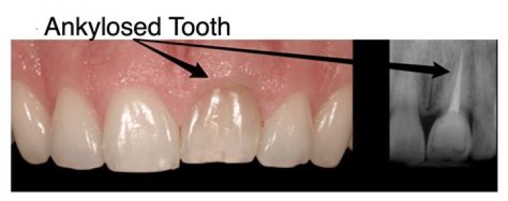 How do you fix an Ankylosed tooth