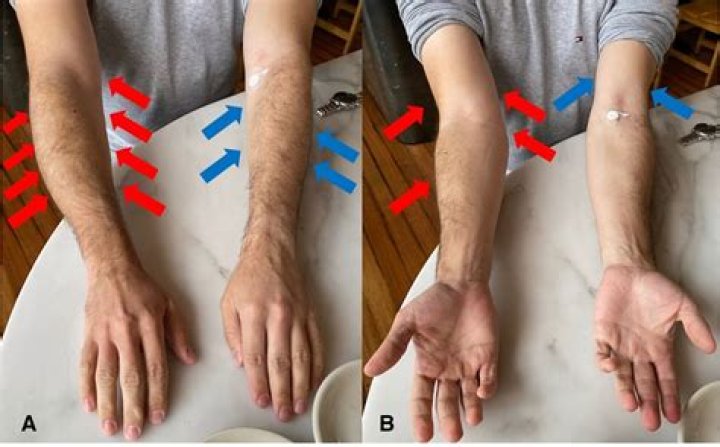 How do you get rhabdomyolysis