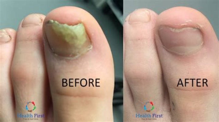 How do you test for onychomycosis