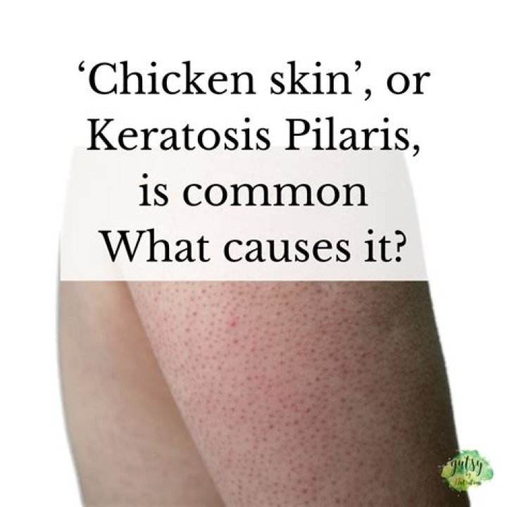 How fattening is chicken skin