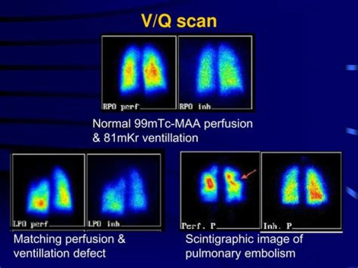 How long does a lung VQ scan take