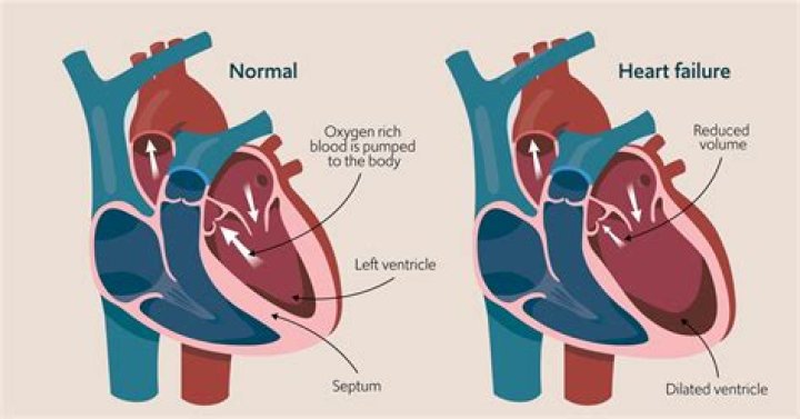 Is Cor pulmonale the same as congestive heart failure