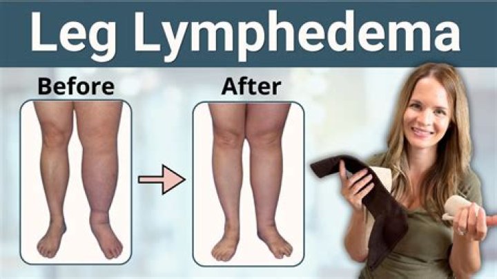 Is there a cure for elephant legs