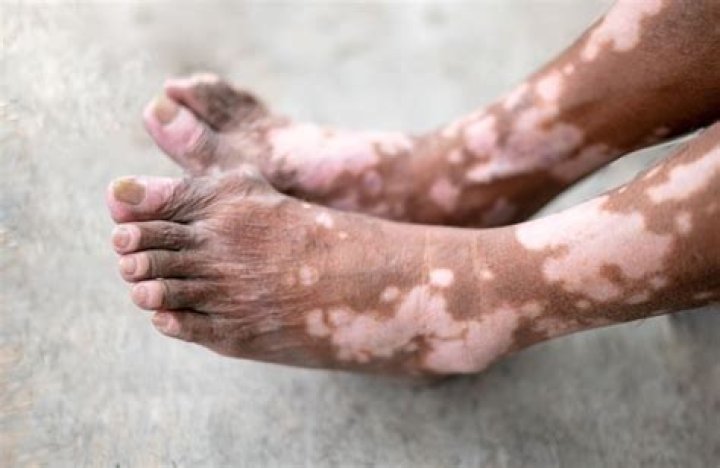 ¿Qué causa la pérdida de melanina