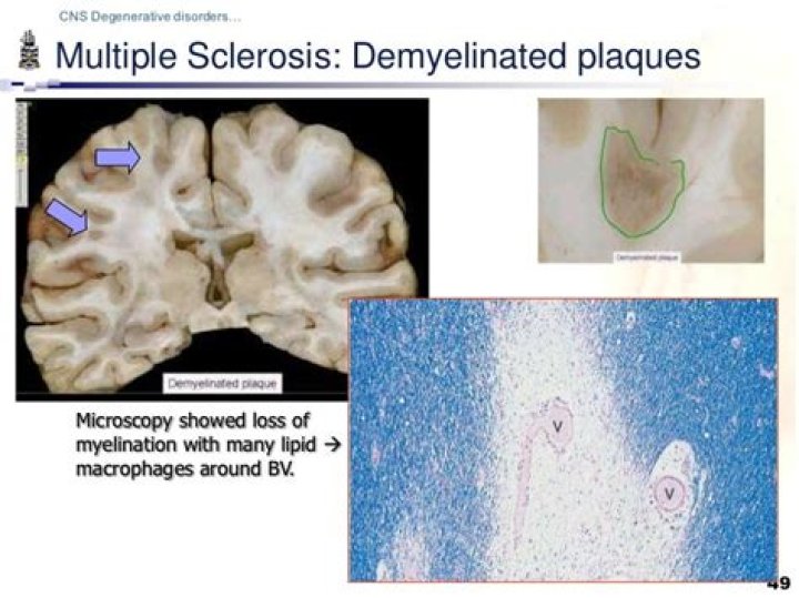What are demyelinating plaques