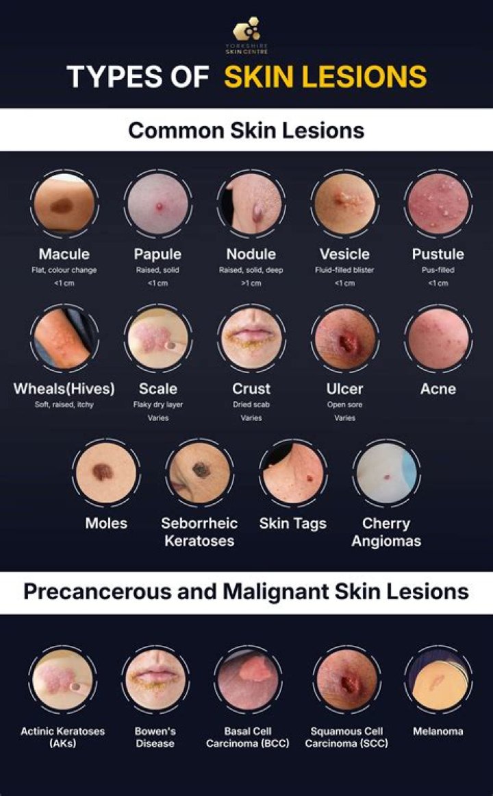 What are the different types of benign and malignant skin lesions
