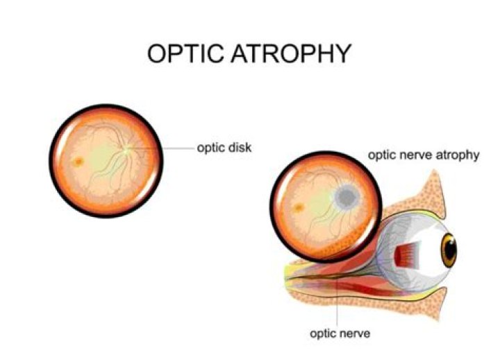 What causes atrophy of the eye