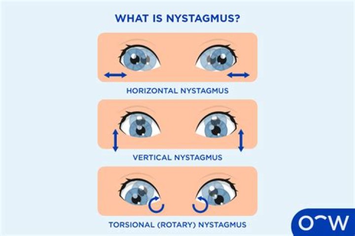 What causes vertical nystagmus