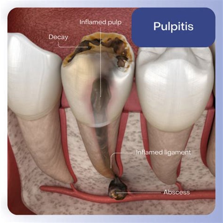 What color is infected tooth pulp