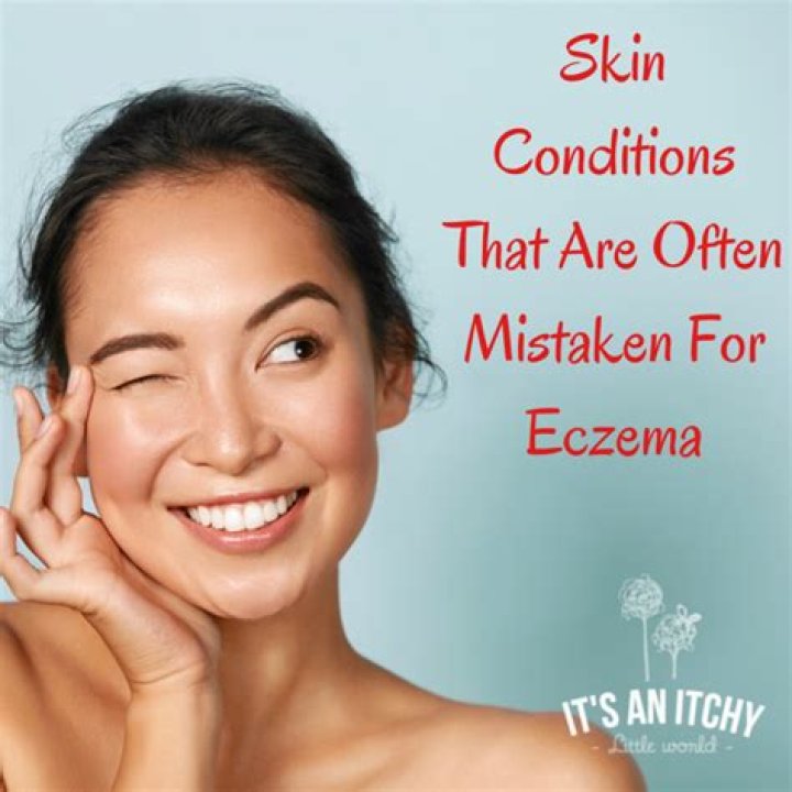What gets mistaken for eczema