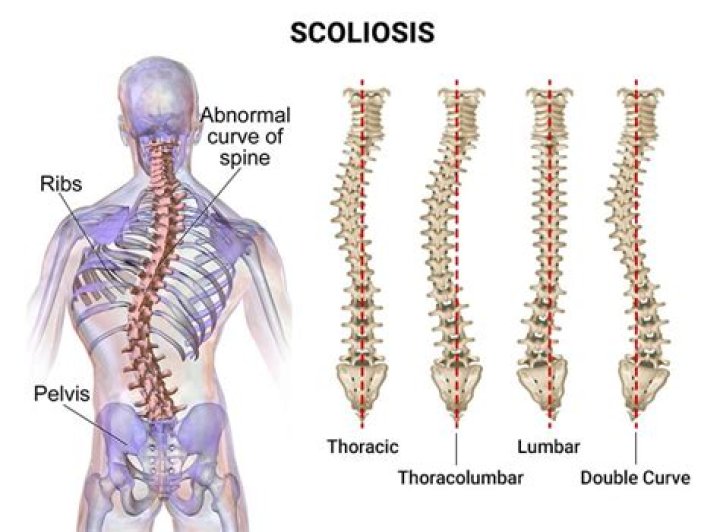 What is lumbar scoliosis