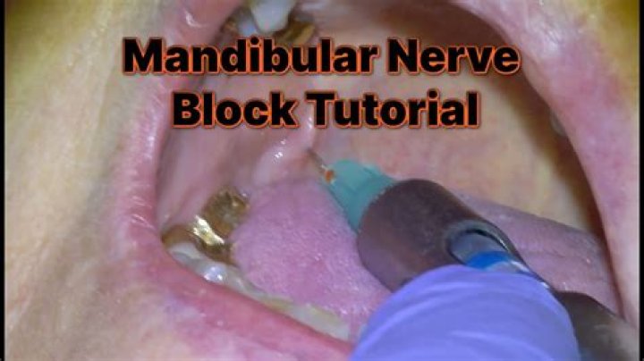 What is mandibular nerve block