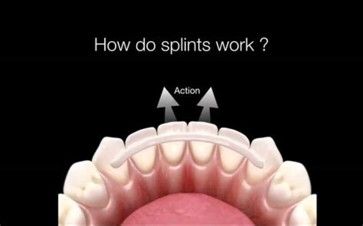 What is splinting in dentistry