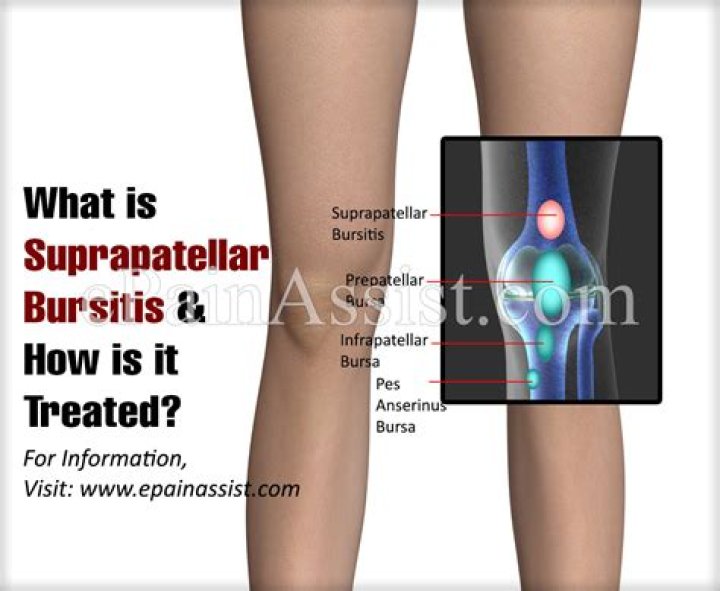 What is Suprapatellar bursitis