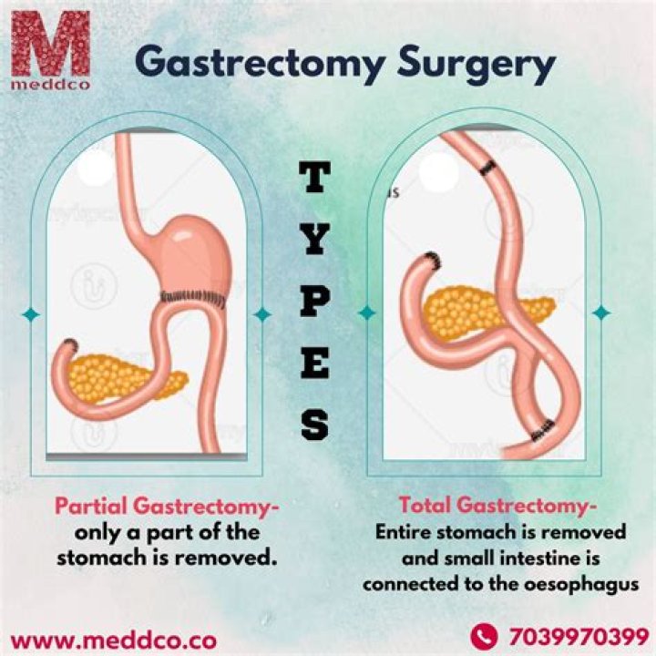 When is subtotal gastrectomy done