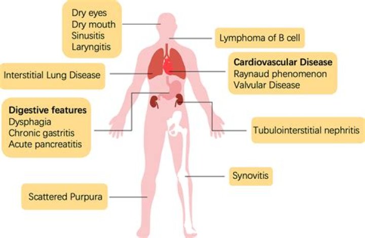 Which is worse Sjogrens or lupus